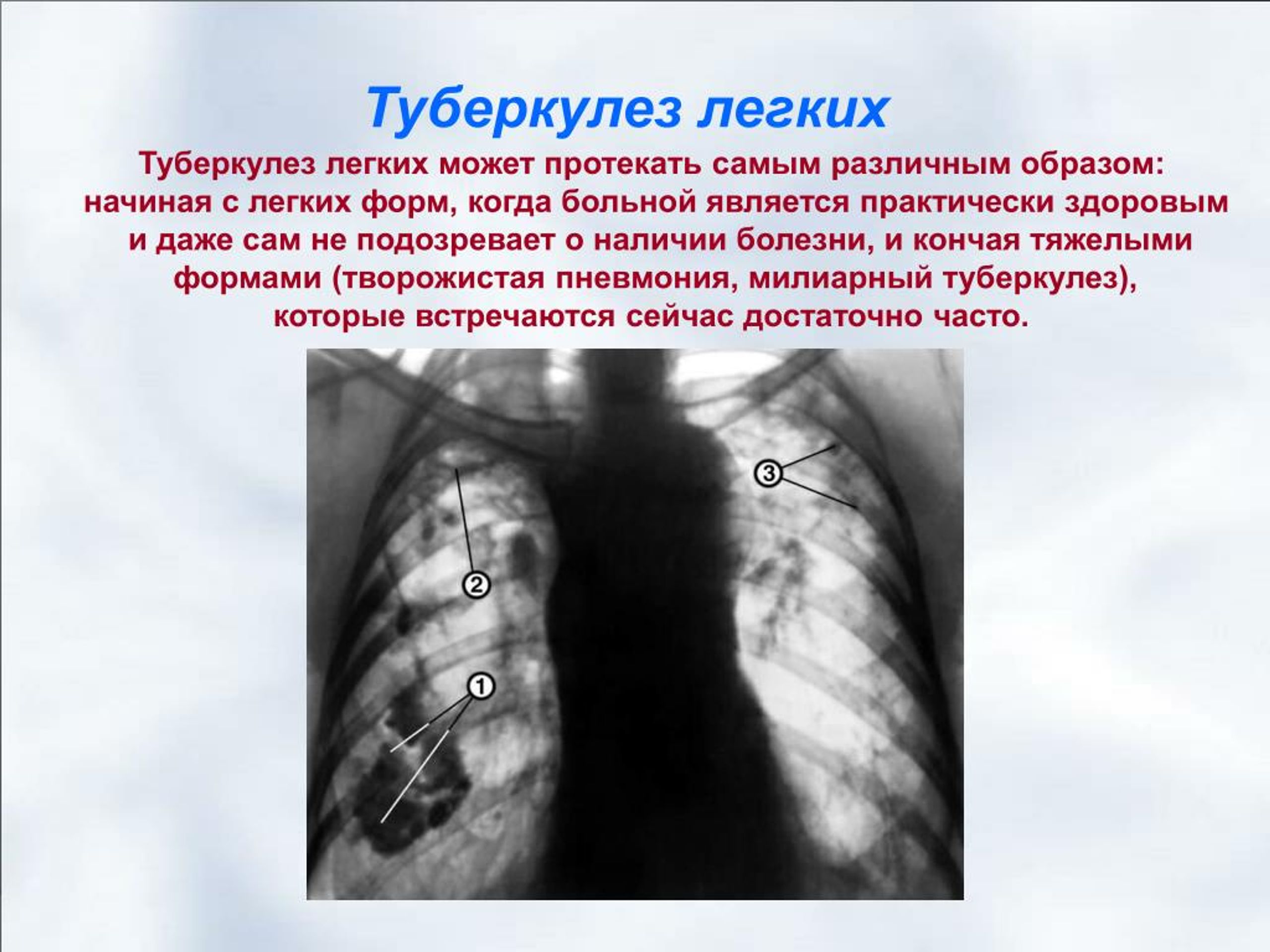 Туберкулез 7 класс. Туберкулёз открытой формы. Лёгкие больного туберкулезом.