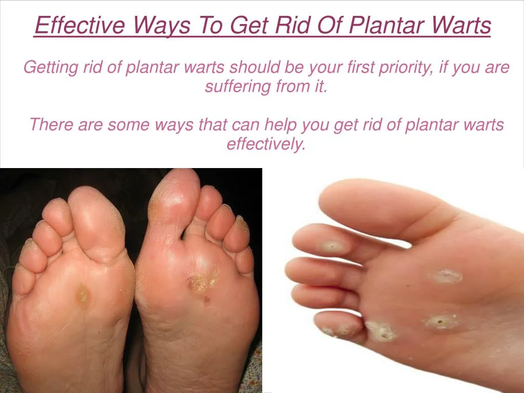 PPT Effective Ways To Get Rid Of Plantar Warts