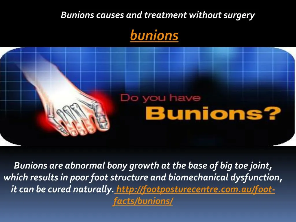 PPT - Bunions Causes And Treatment Without Surgery PowerPoint ...