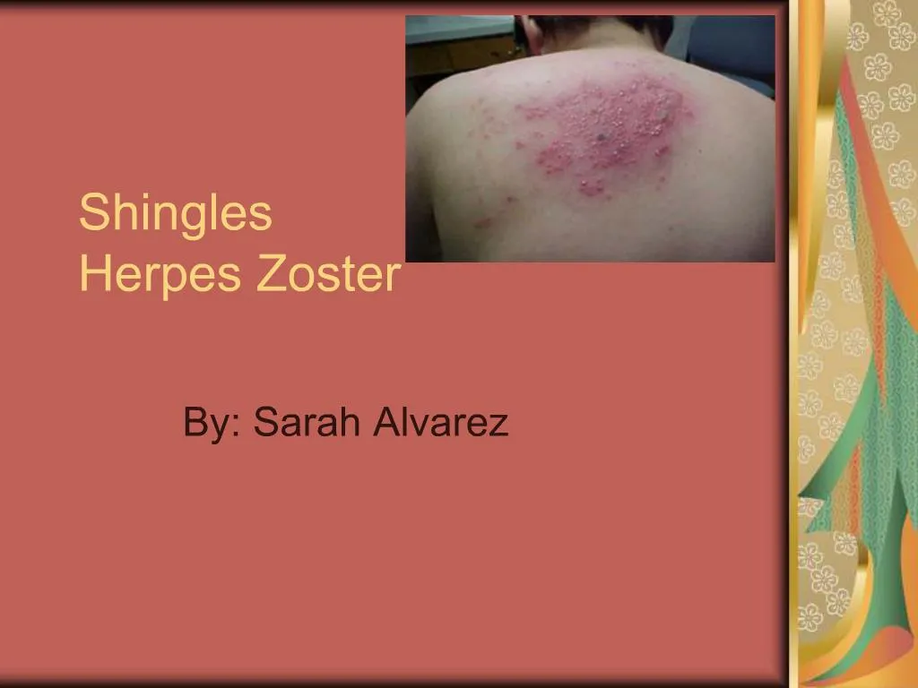 presentation of herpes zoster