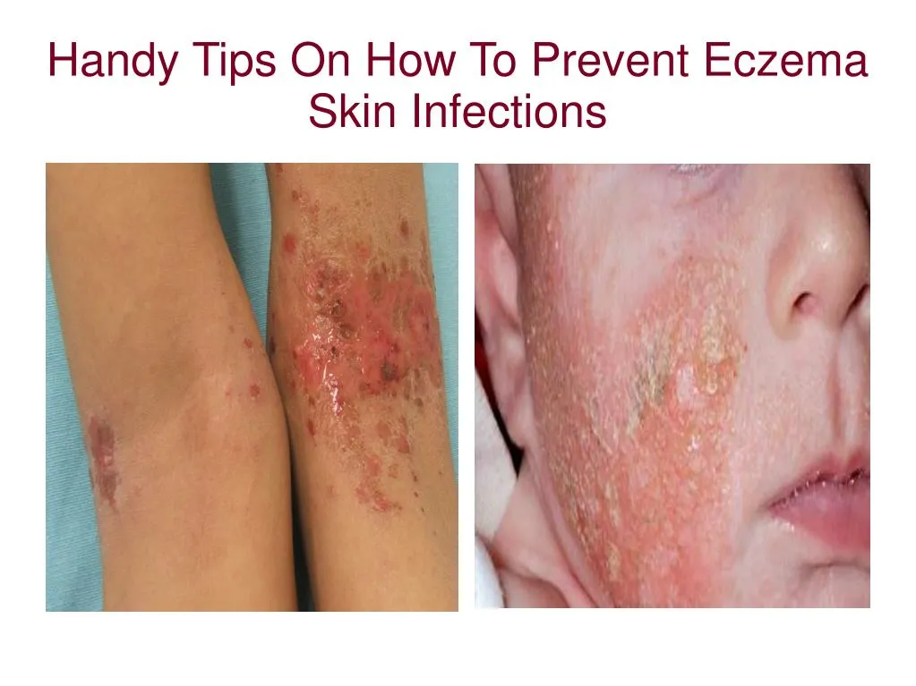 PPT - Handy Tips On How To Prevent Eczema Skin Infections PowerPoint ...