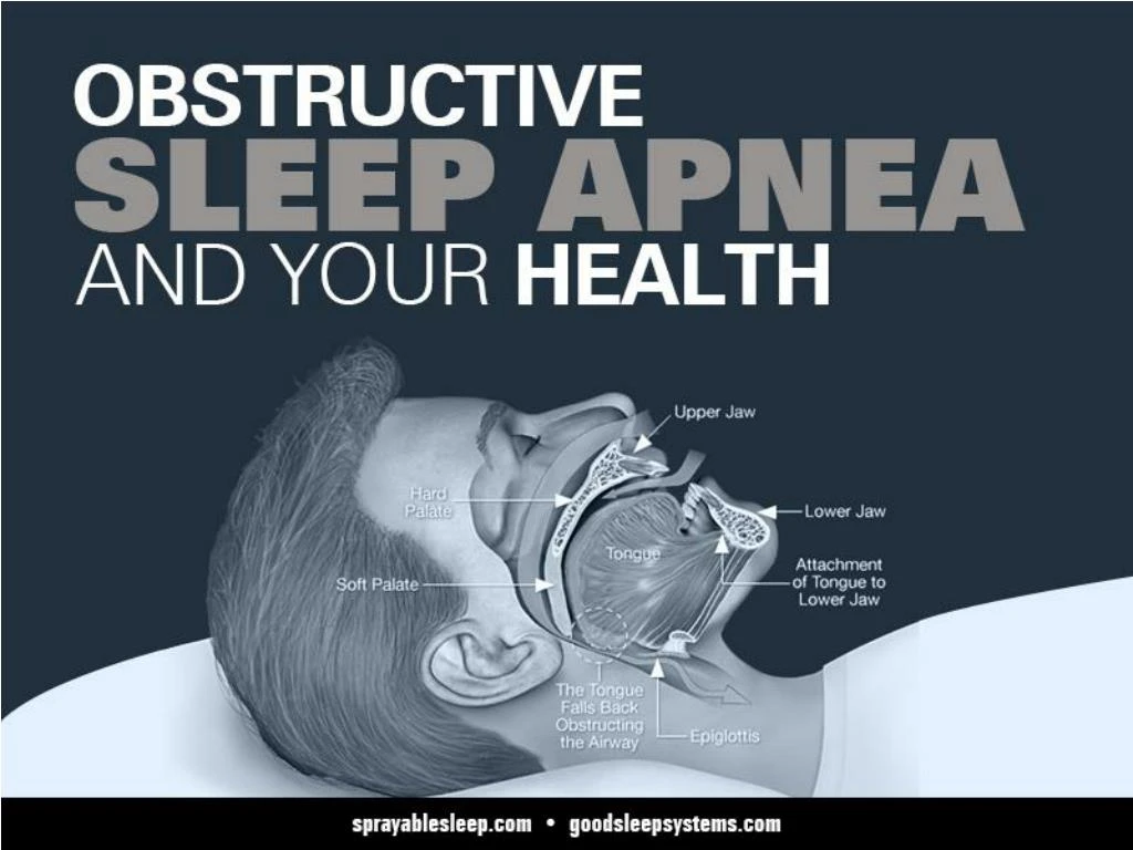 powerpoint presentation on sleep apnea