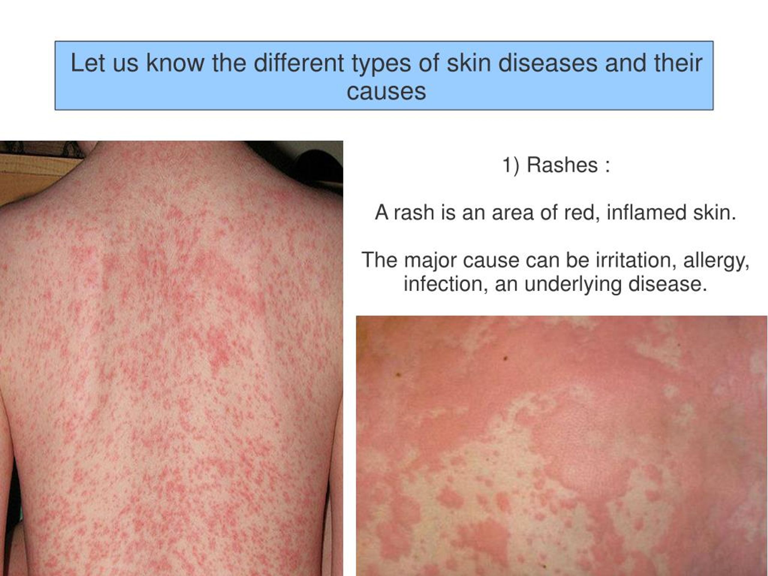 PPT - Different Types Of Skin Diseases And Their Causes ...