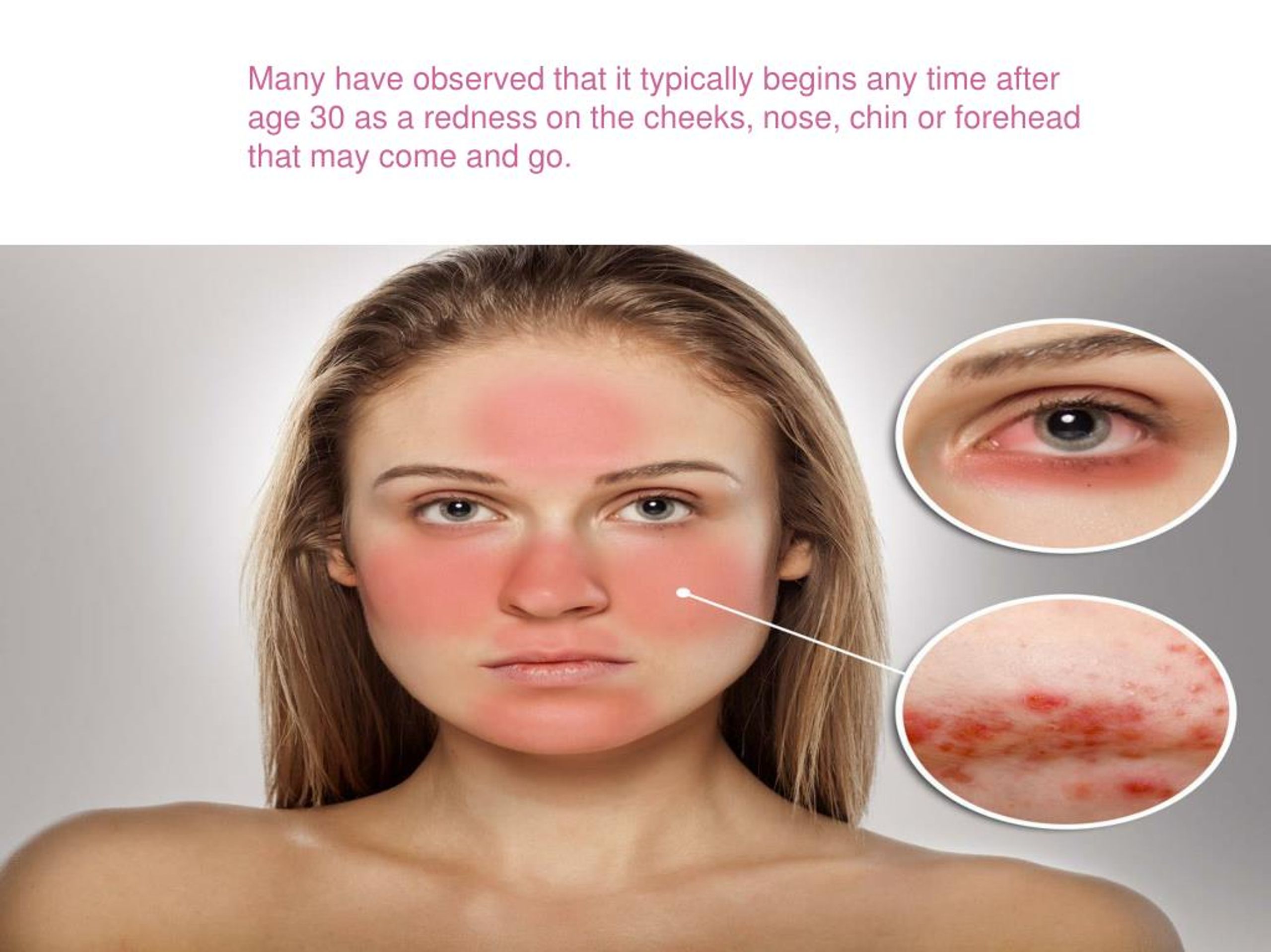 Rosacea ocular tratamiento