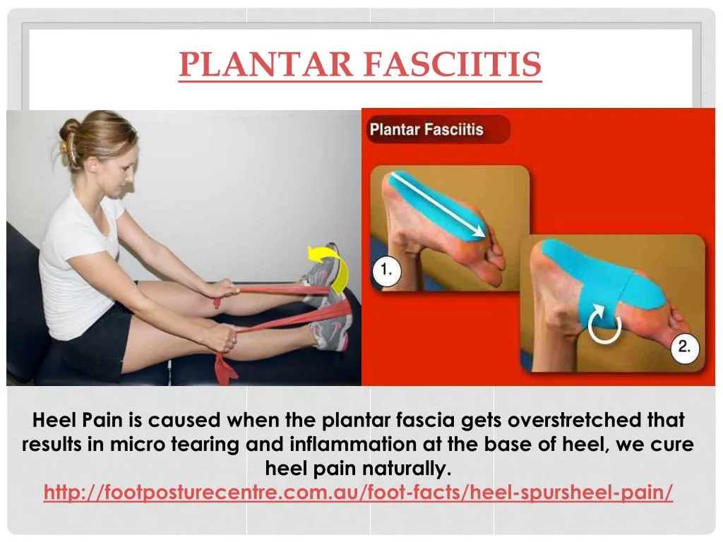cure for fasciitis