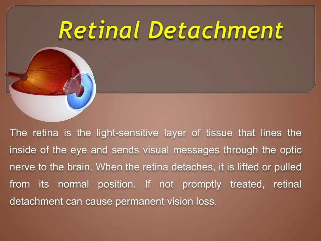 ppt-retinal-detachment-powerpoint-presentation-free-download-id