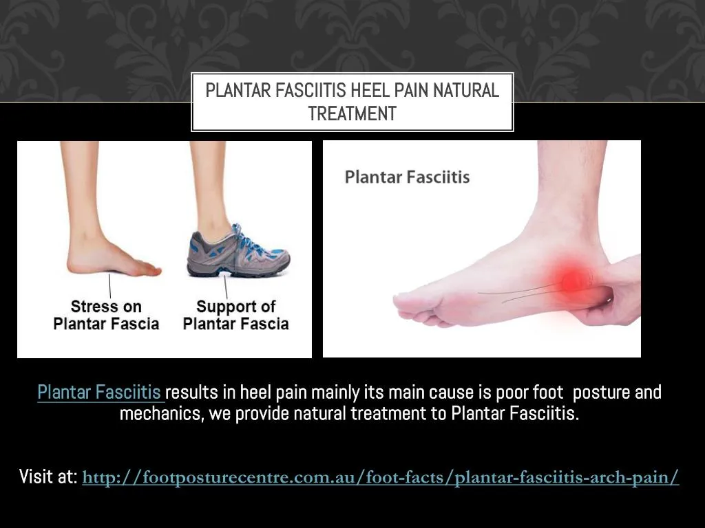 plantar fasciitis natural treatment