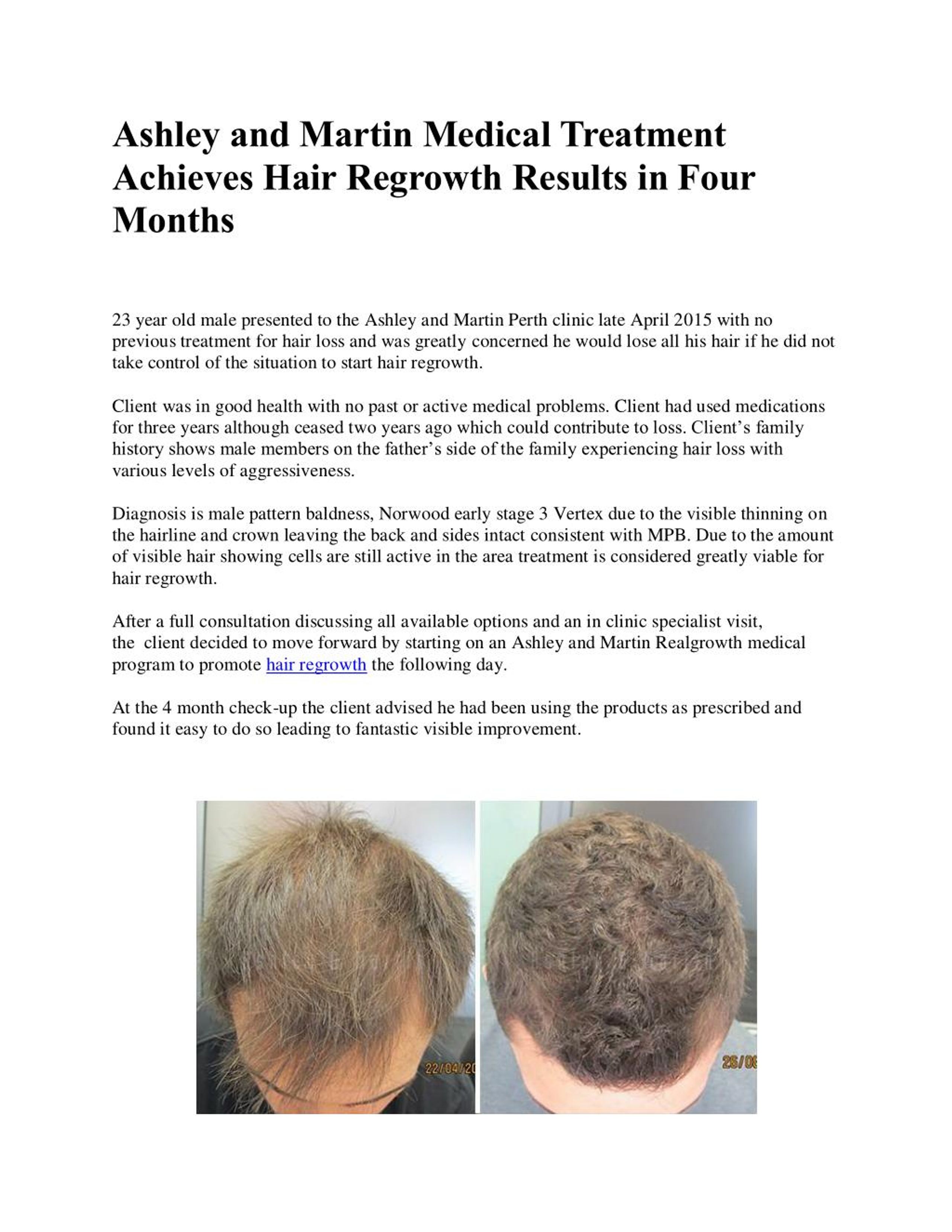 PPT - Ashley and Martin Medical Treatment Achieves Hair Regrowth Results in Four  Months PowerPoint Presentation - ID:7303375