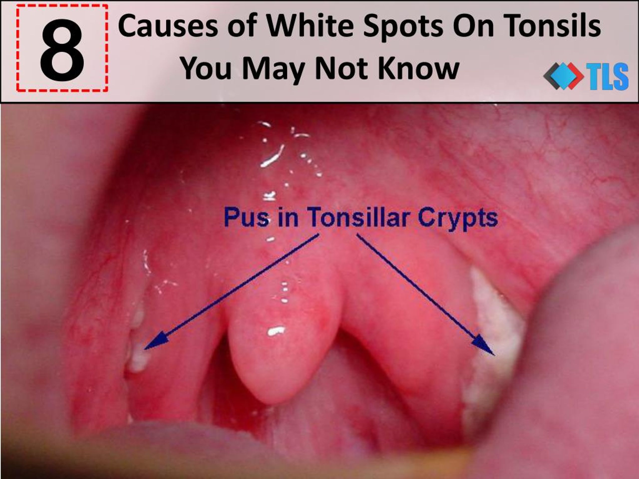 Ppt 8 Causes Of White Spots On Tonsils You May Not Know Powerpoint Presentation Id7321615