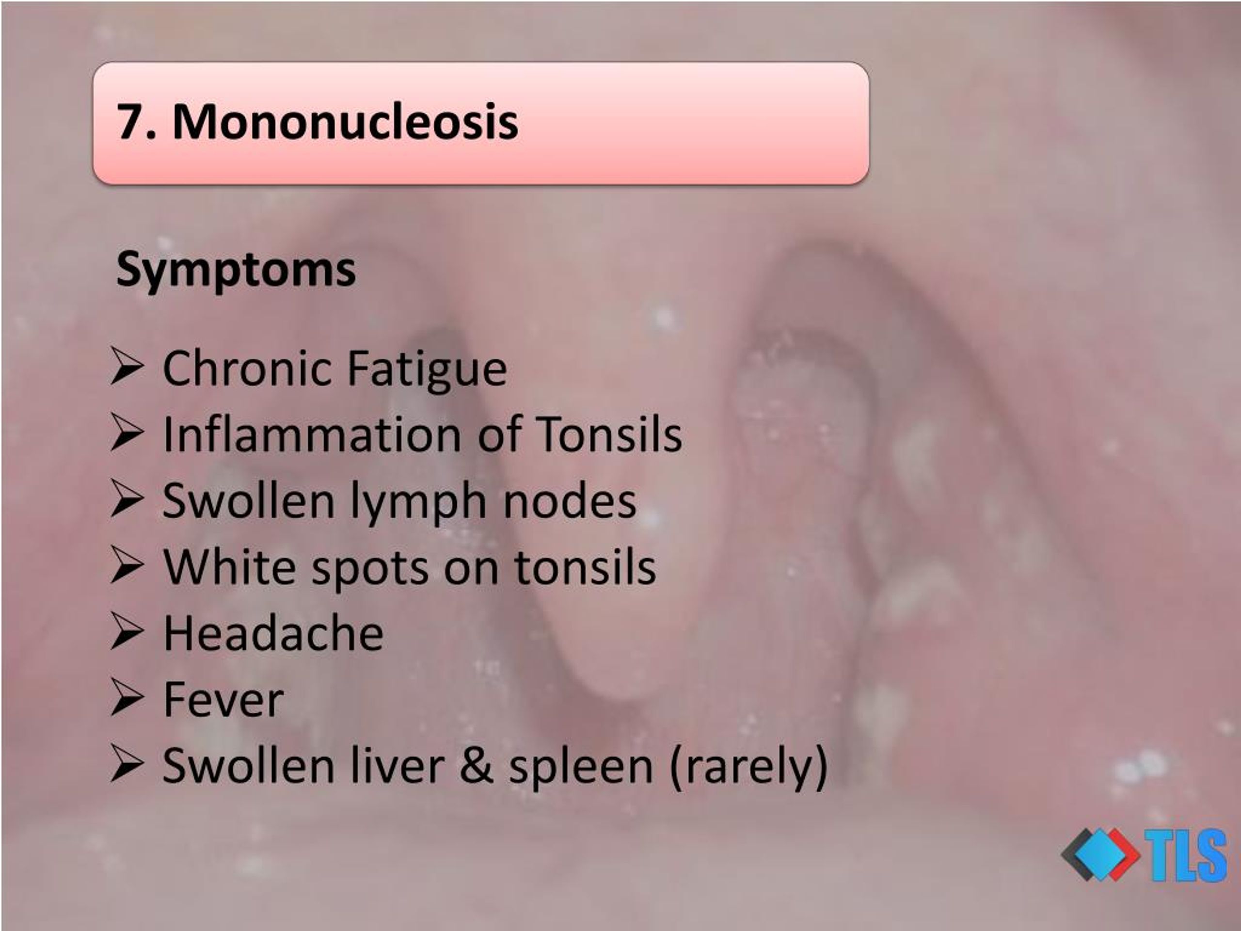 PPT - 8 Causes of White Spots On Tonsils You May Not Know PowerPoint ...