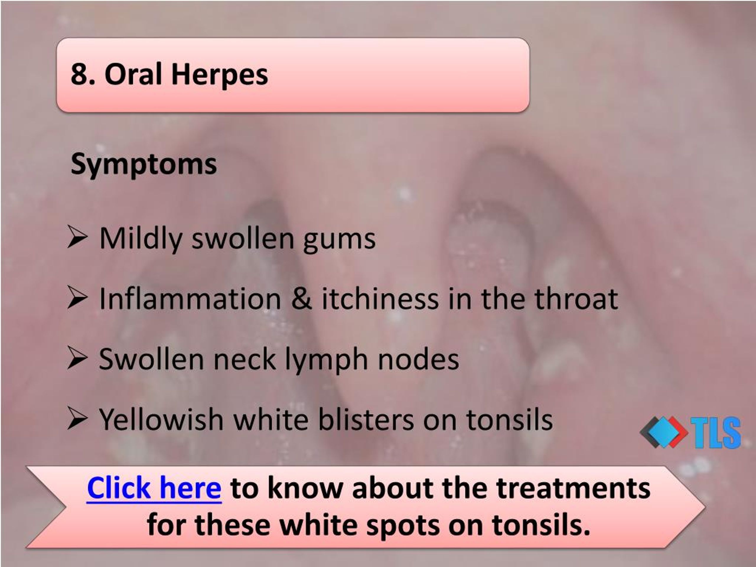 Ppt 8 Causes Of White Spots On Tonsils You May Not Know Powerpoint Presentation Id7321615