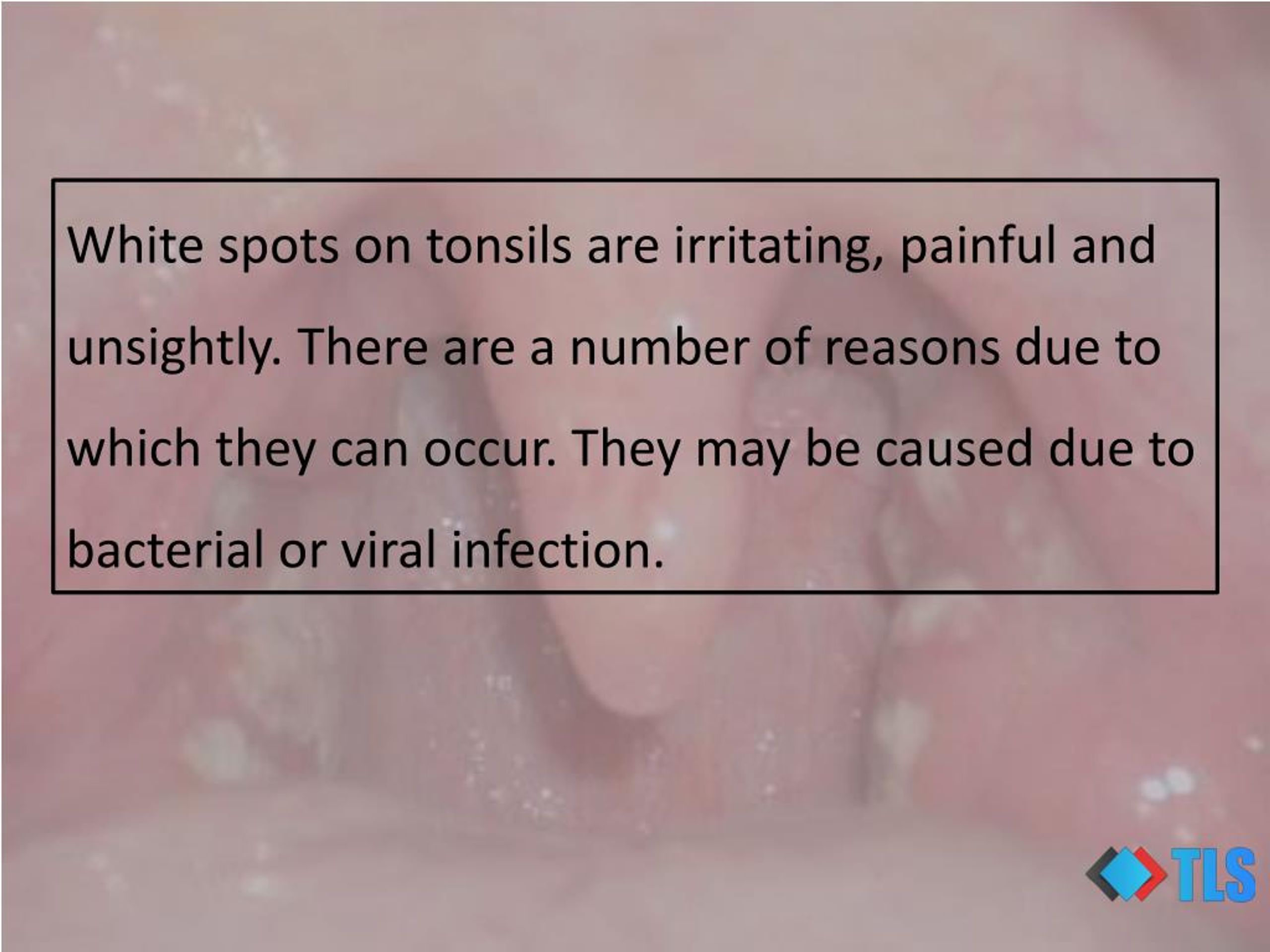 PPT - 8 Causes of White Spots On Tonsils You May Not Know PowerPoint ...