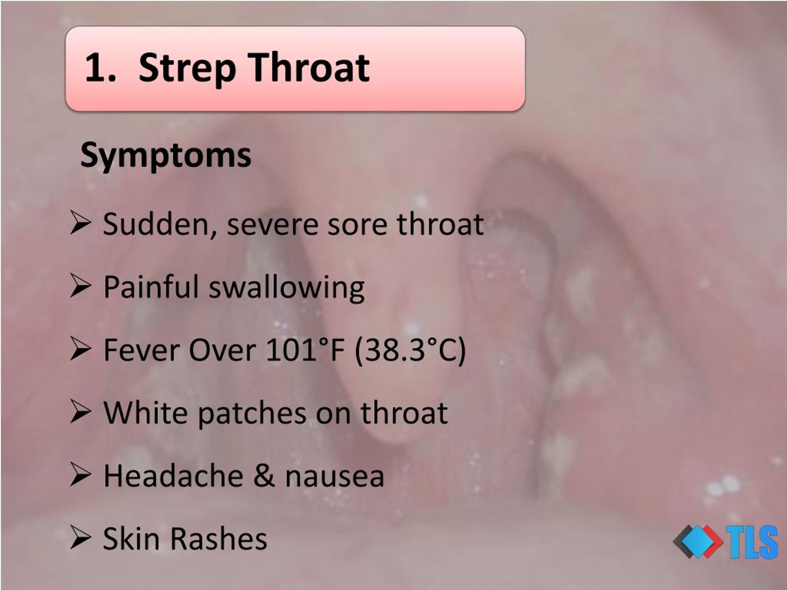 Yellow Spots On Tonsils