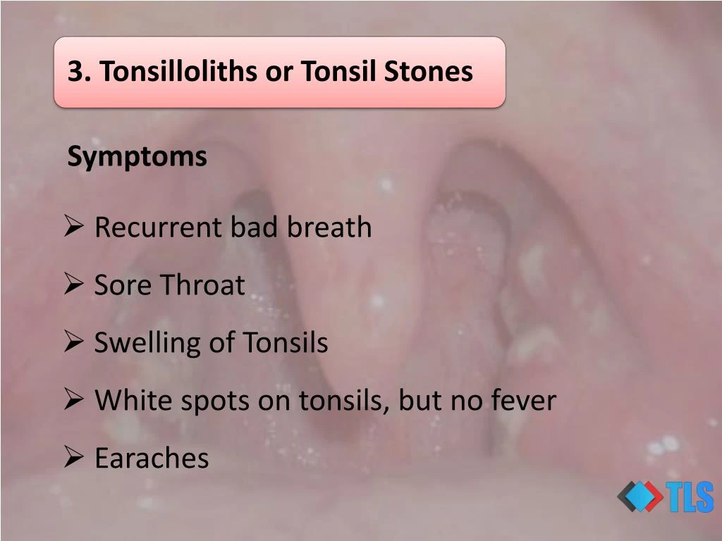 White Spots On Tonsils With No Fever | Images and Photos finder