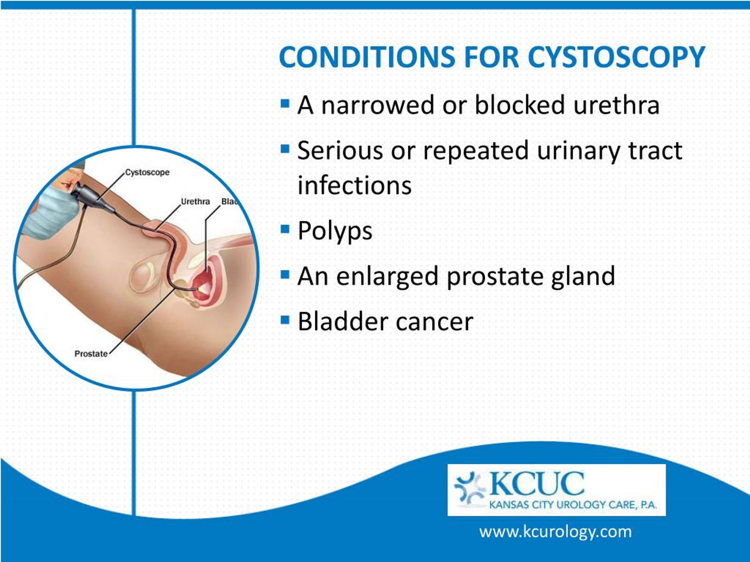 PPT Cystoscopy Detect and Treat Symptoms of Bladder Cancer