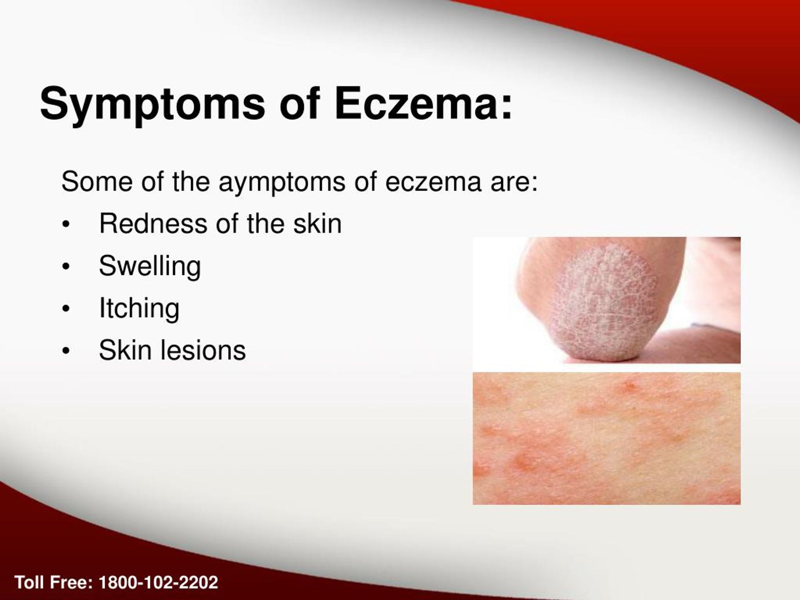 PPT - Eczema Skin Problem Causes And Symptoms PowerPoint Presentation ...