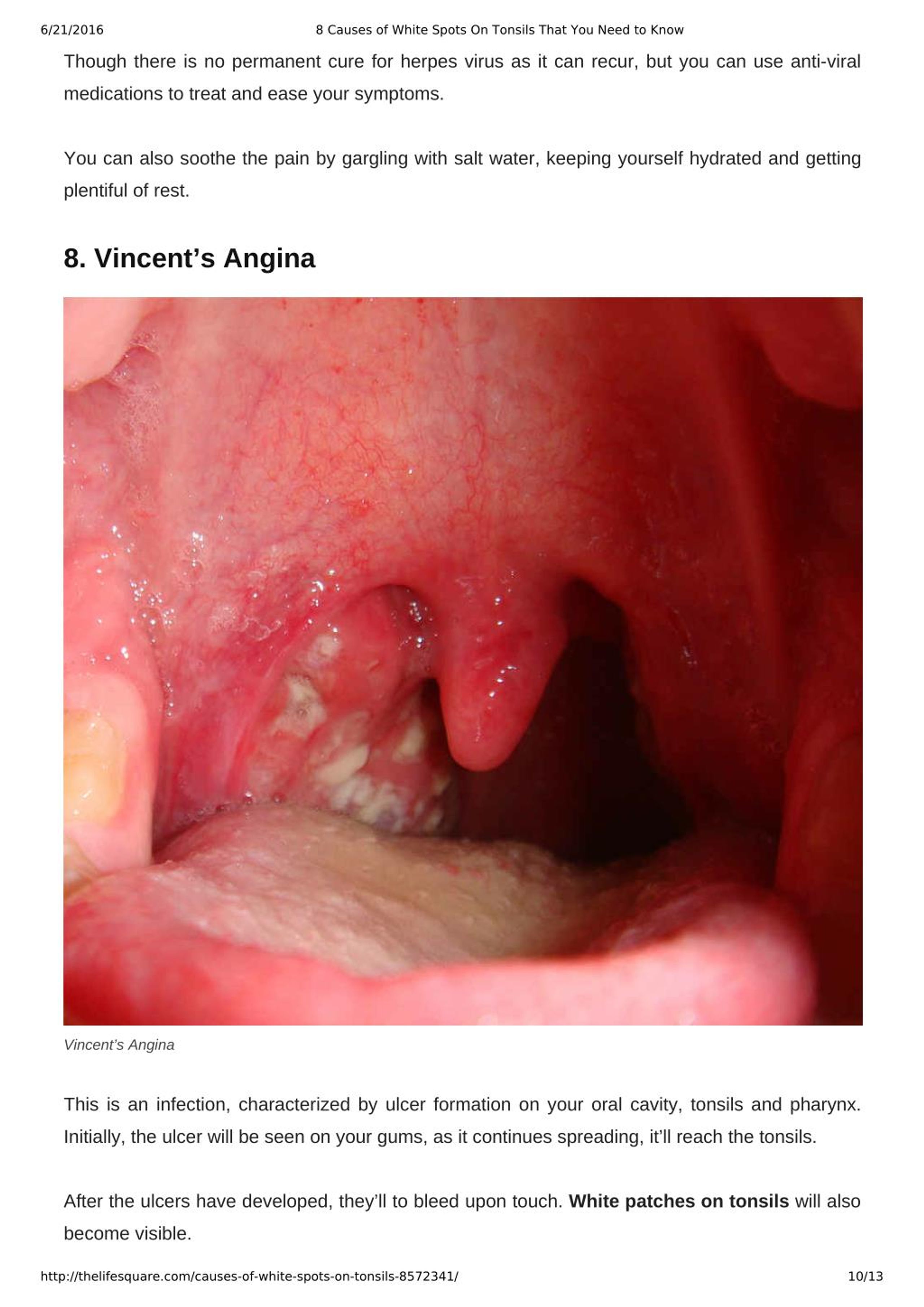 What Can Cause White Patches In Throat