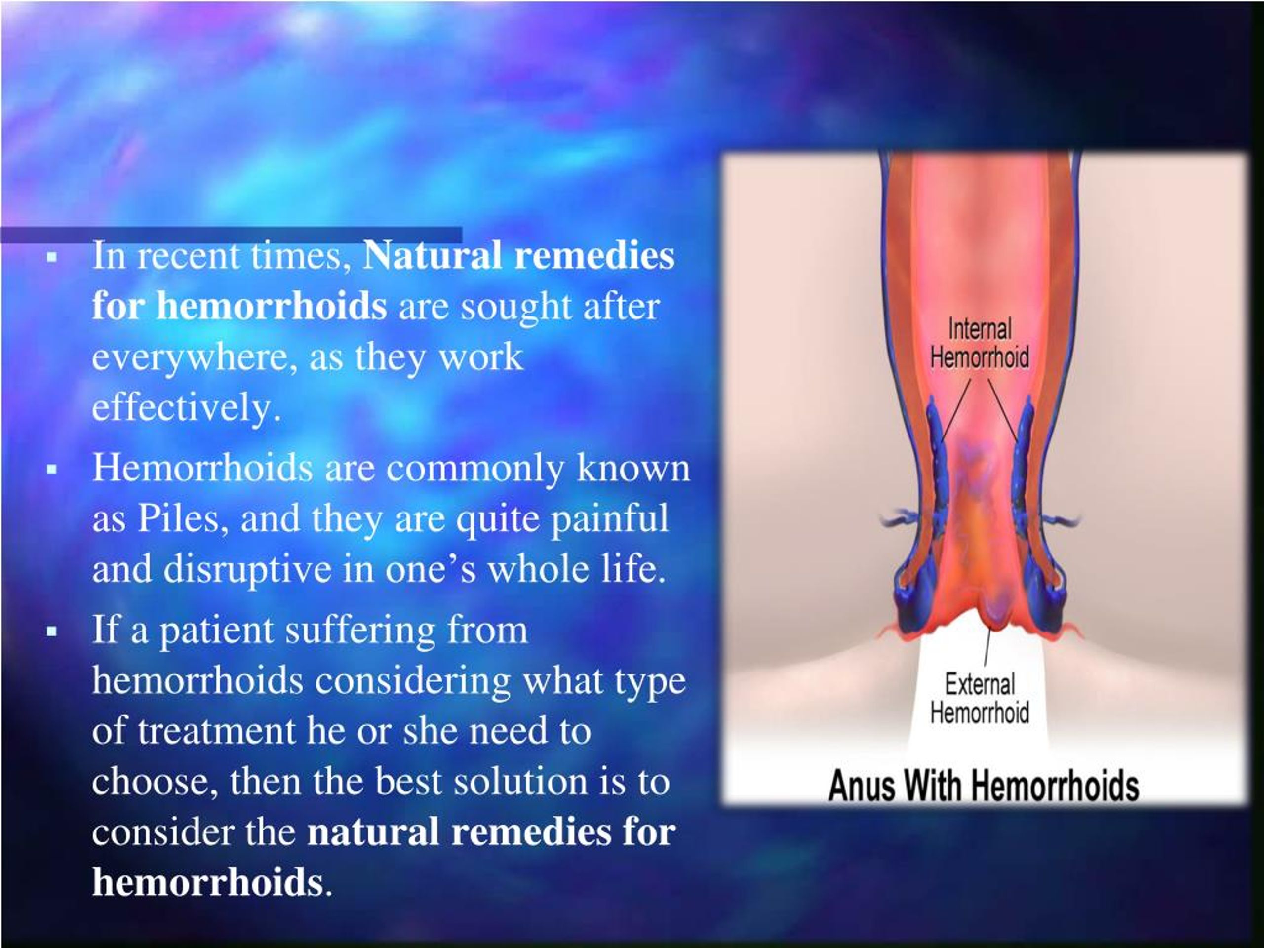 Ppt Natural Remedies For Hemorrhoids A Smarter And Swifter Way Powerpoint Presentation Id 4590