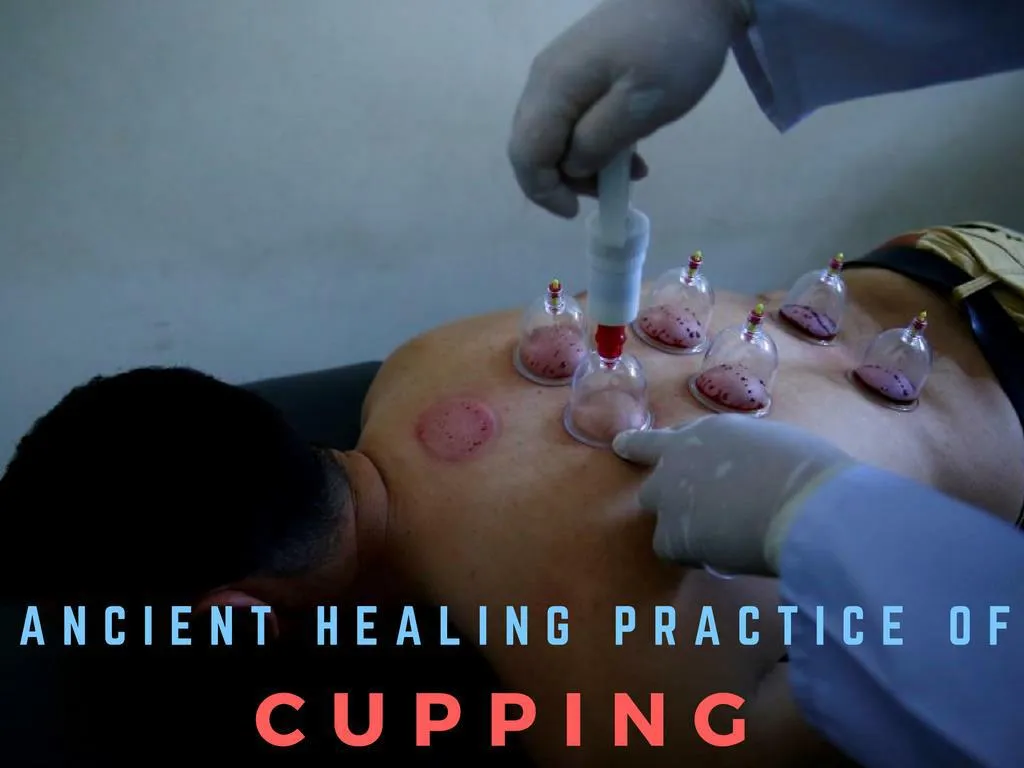 antiquated recuperating routine of cupping n.
