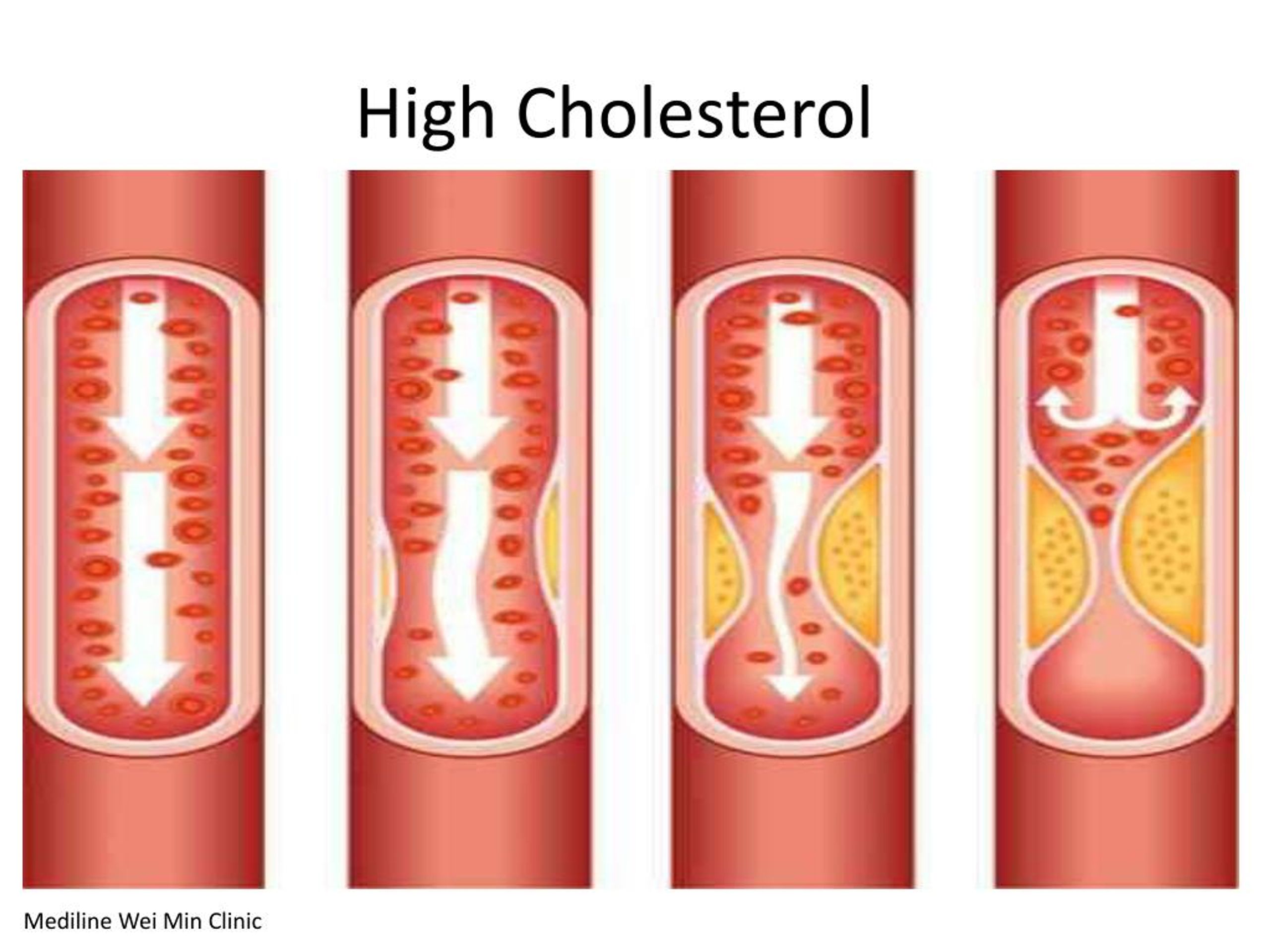 Colesterol alto tratamiento