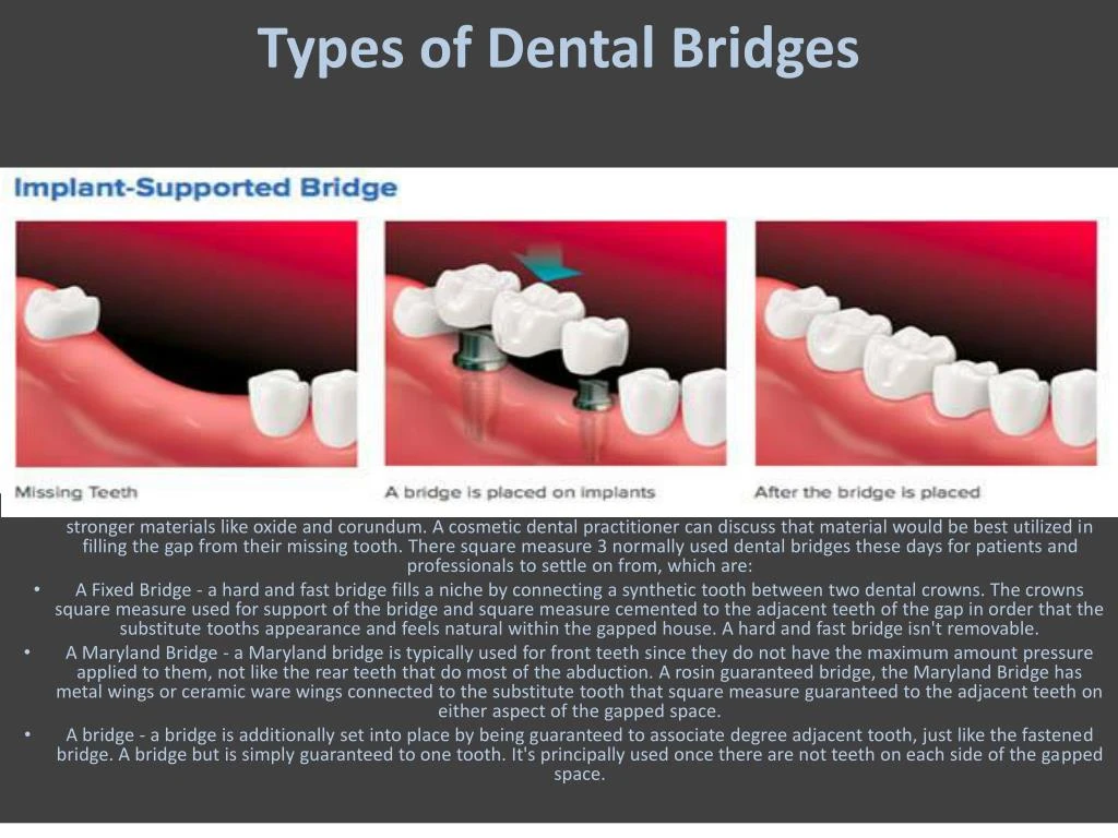 PPT - Dental Bridge And It's Benefits PowerPoint Presentation - ID:7398181