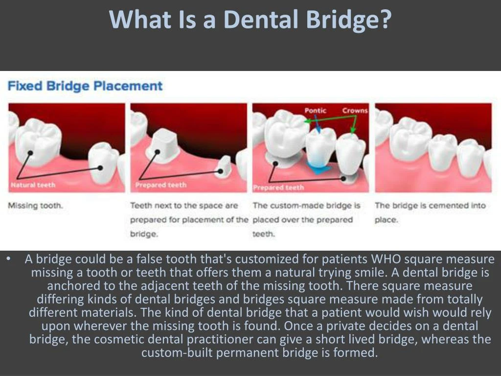 PPT Dental Bridge And It's Benefits PowerPoint Presentation ID7398181