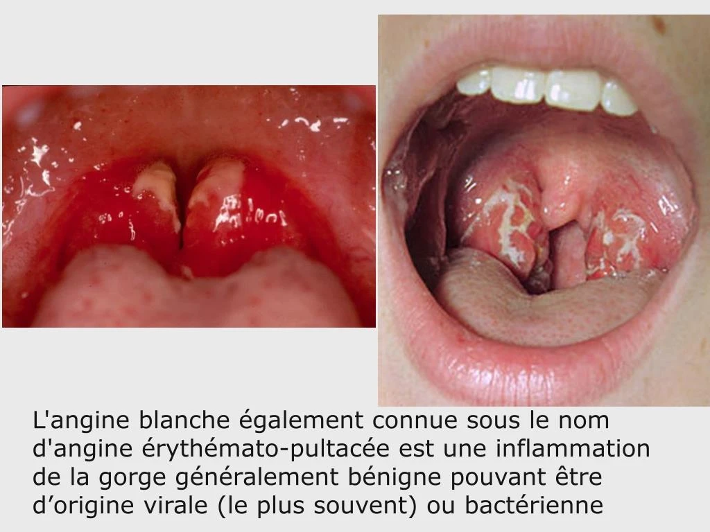 ppt fièvre de l enfant powerpoint presentation id 7419069