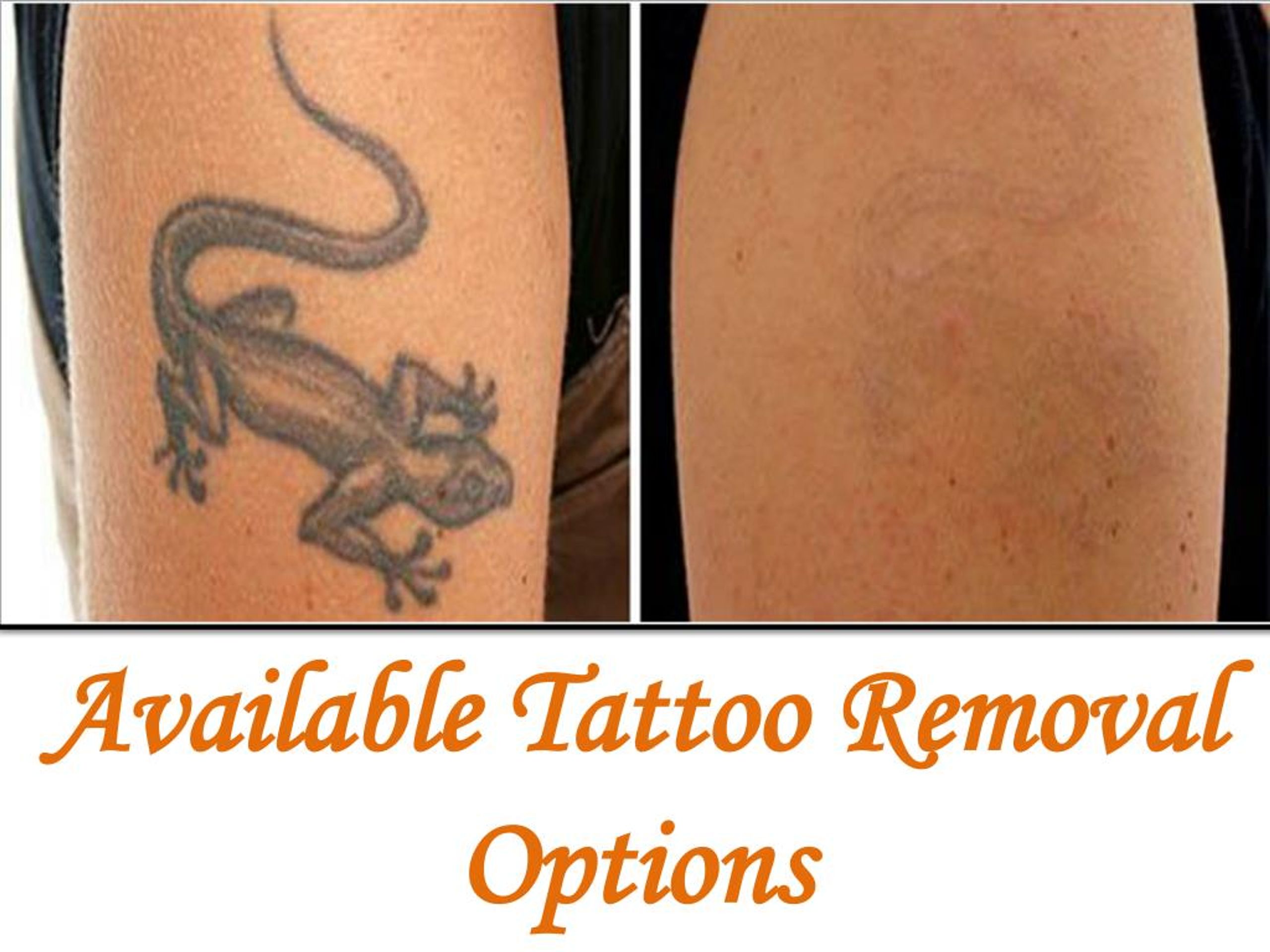 PPT Available Tattoo Removal Options PowerPoint