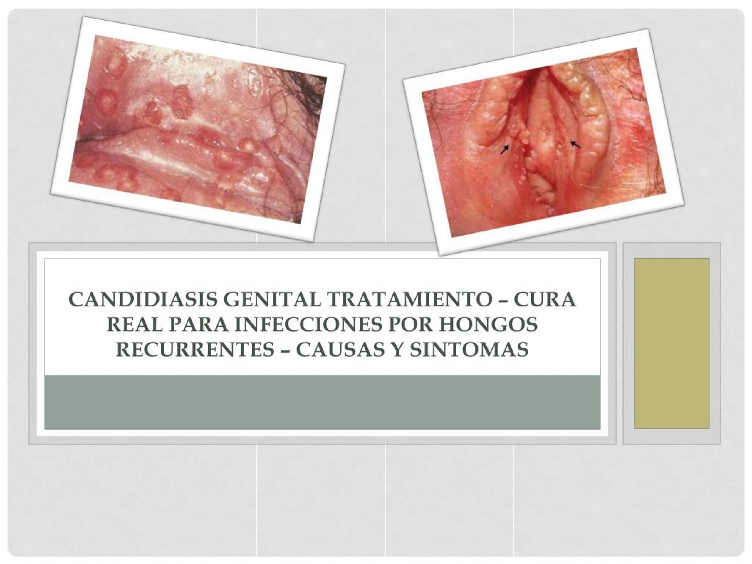 Ppt Candidiasis Genital Tratamiento Cura Real Para Infecciones Por ...