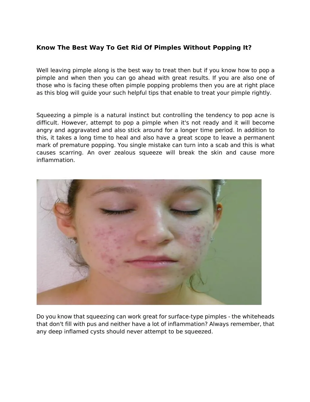 how to get rid of a white pimple without popping it