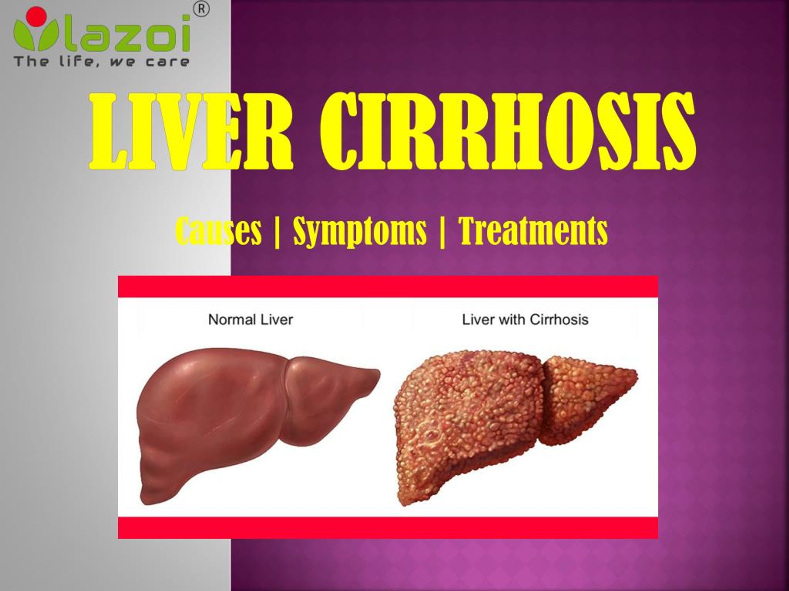 liver cirrhosis case study ppt