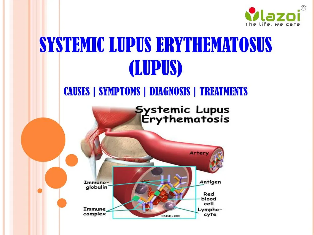 PPT - Systemic Lupus Erythematosus (lupus): Disease Of The Immune ...