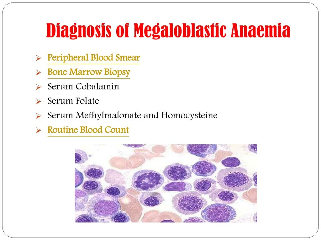 PPT - Megaloblastic Anaemia: Symptoms, causes, diagnosis, treatment and