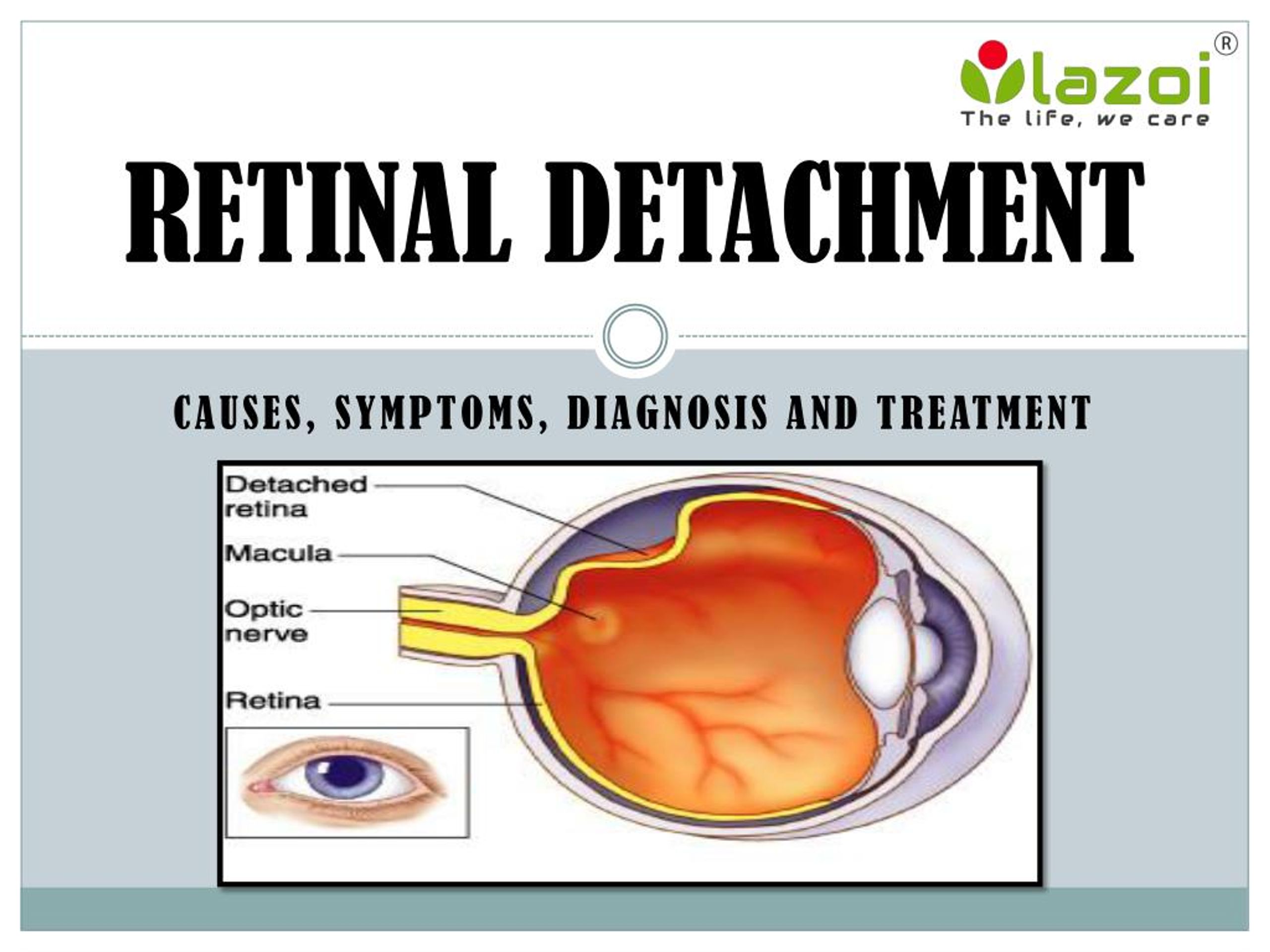 What is a Detached Retina?  Symptoms, Causes and Treatment