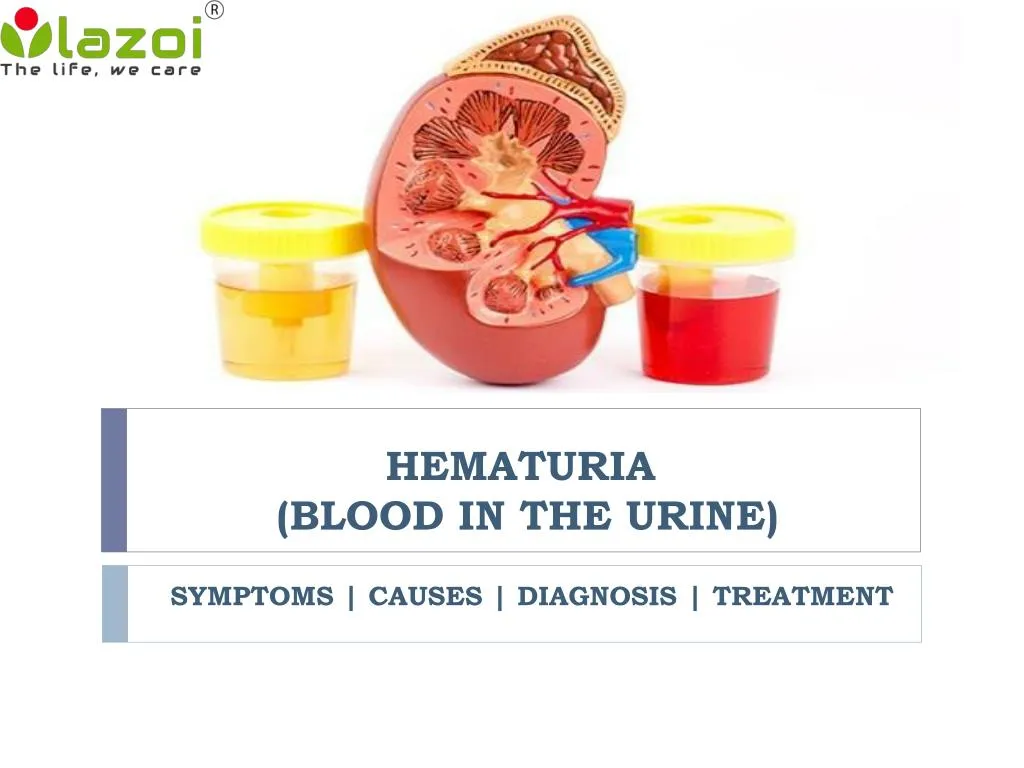 Blood in Urine (Hematuria) : Causes, Picture, Symptoms and 
