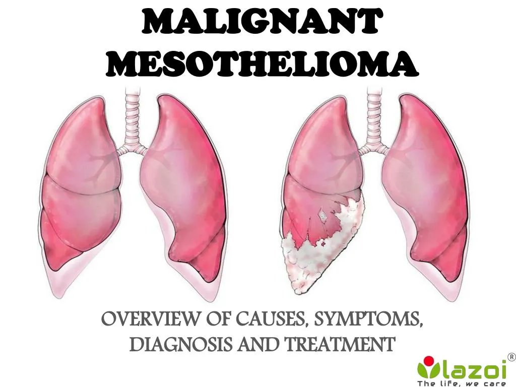 the established and future biomarkers of malignant pleural mesothelioma