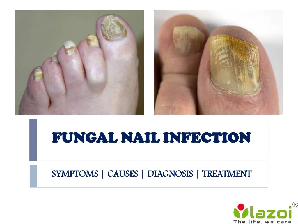 PPT - Fungal Nail Infection: causes, symptoms, diagnosis and treatment ...