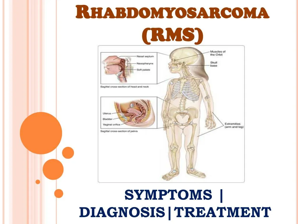 PPT - Rhabdomyosarcoma (RMS): Information on symptoms, diagnosis and