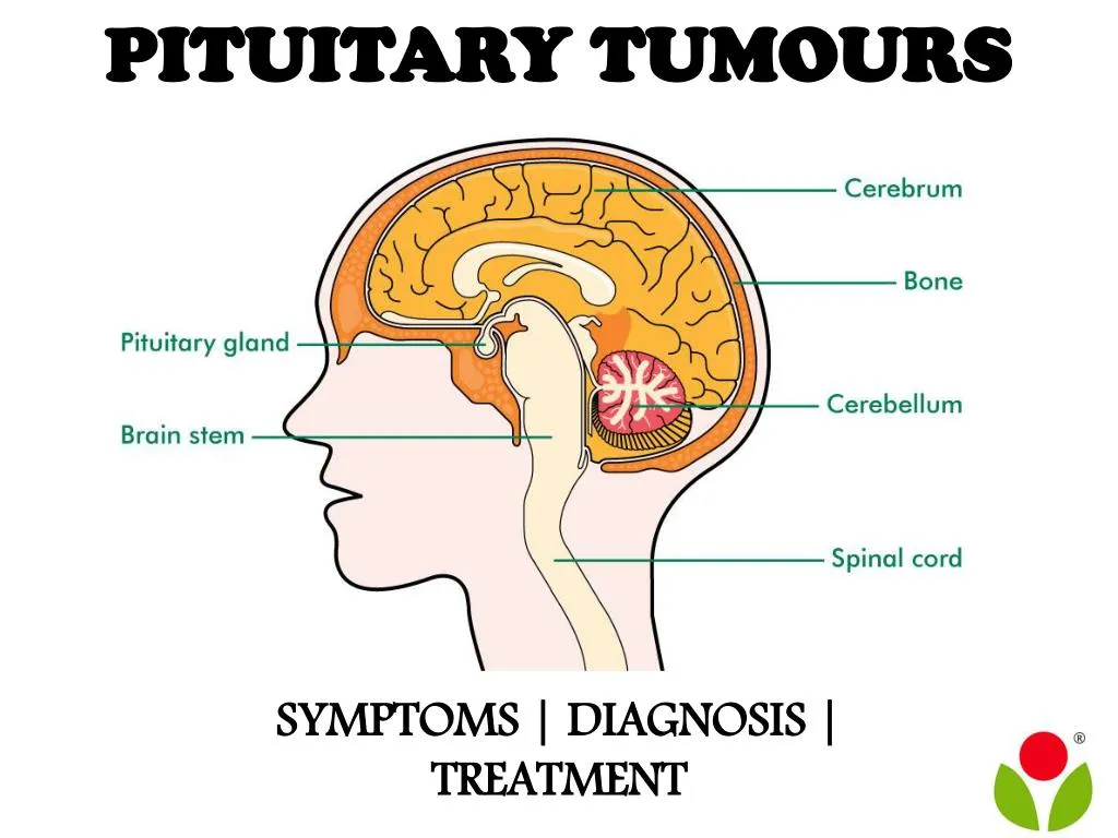PPT Pituitary tumours symptoms, diagnosis and