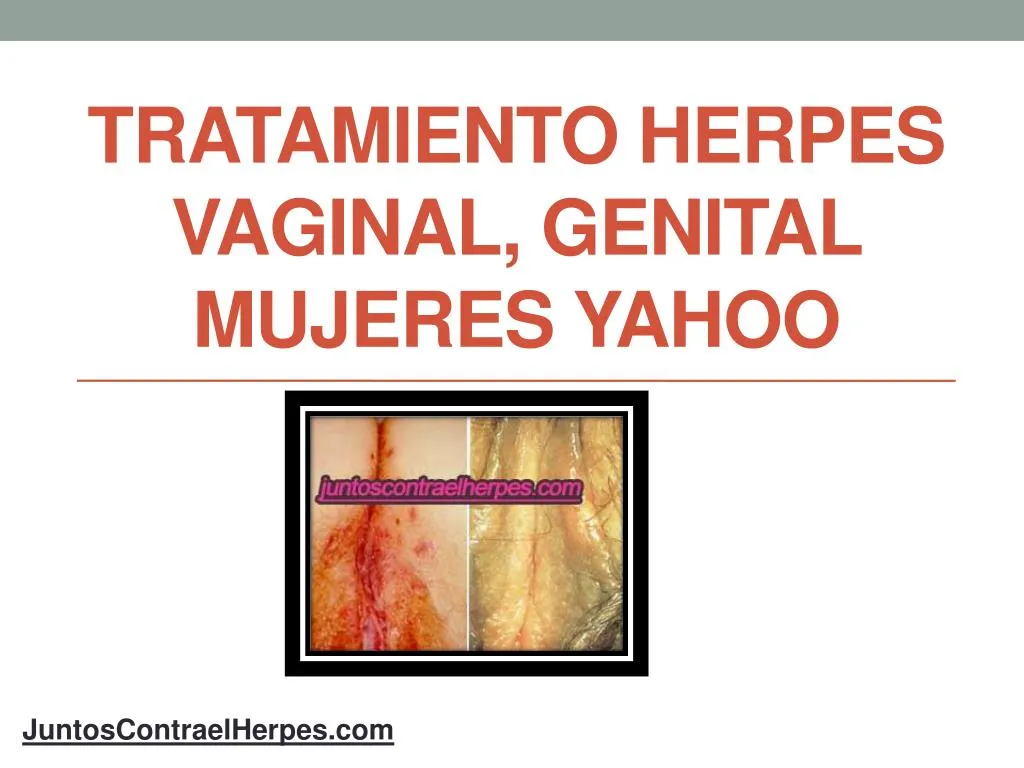tratamiento herpes vaginal genital mujeres yahoo n.