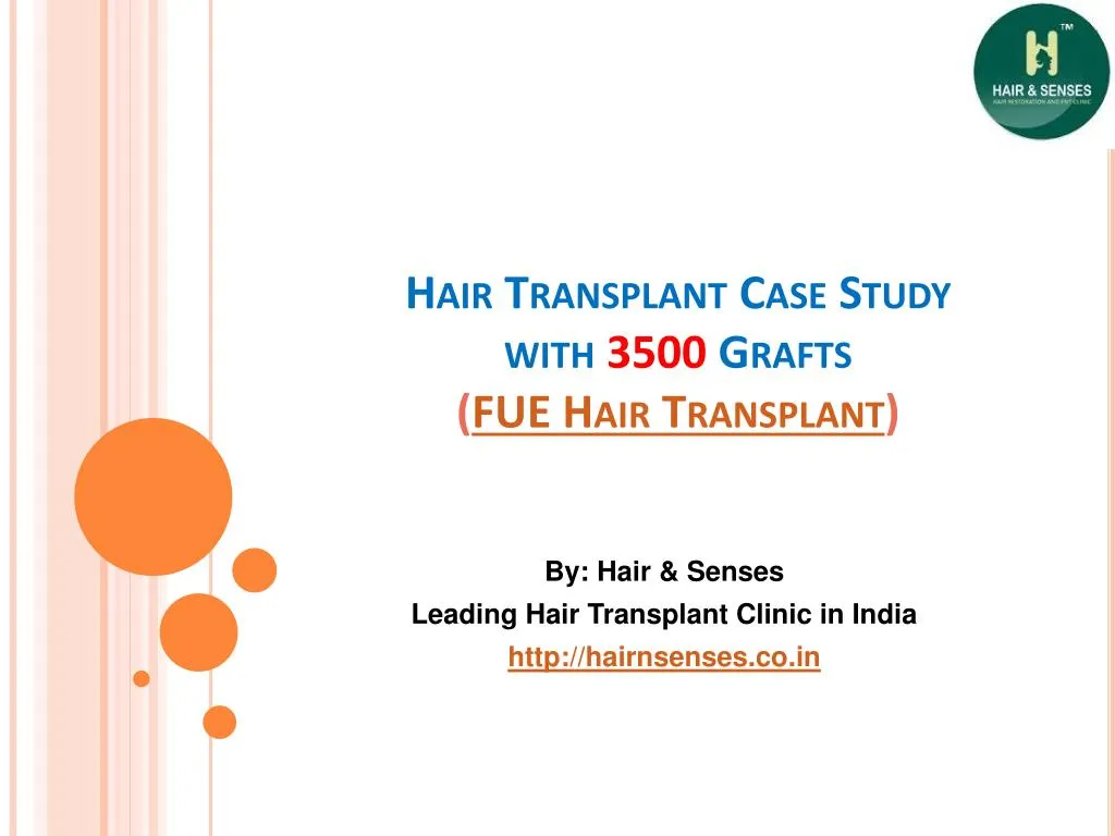 hair transplant case study with 3500 grafts fue hair transplant n.