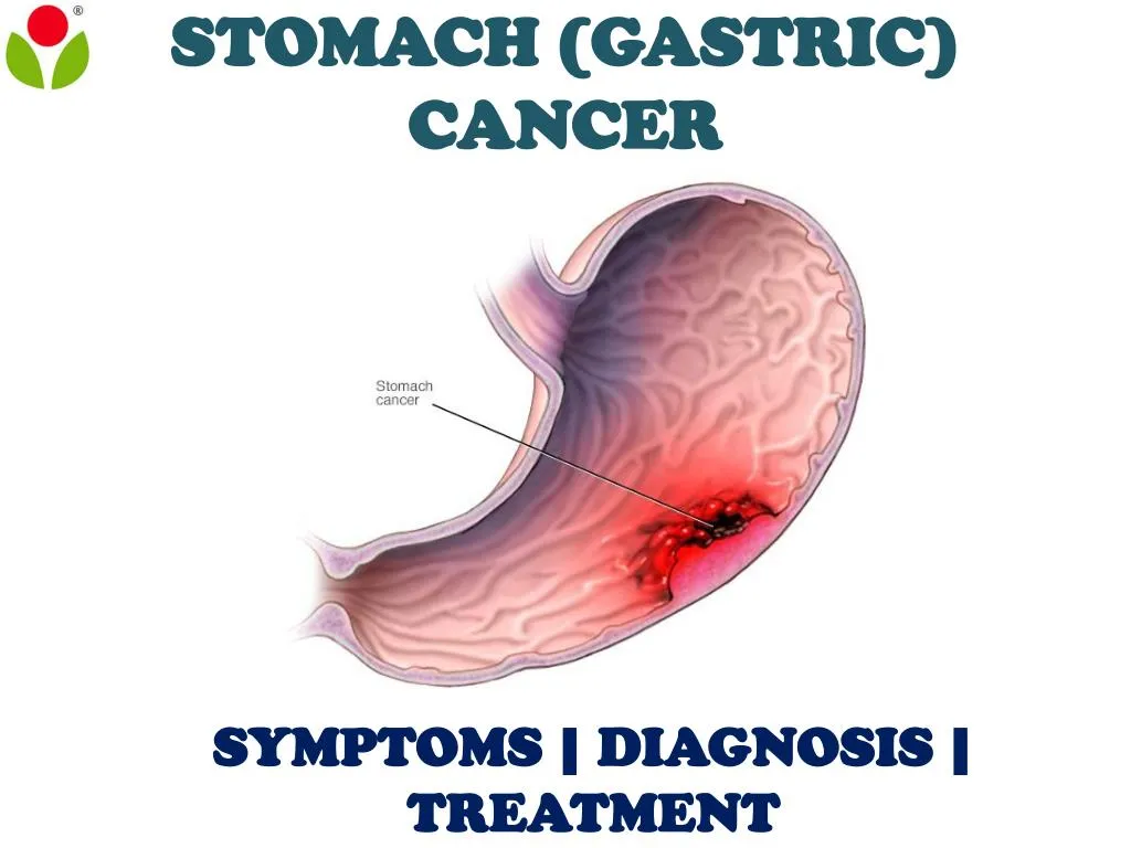 gastric cancer ppt 2021)