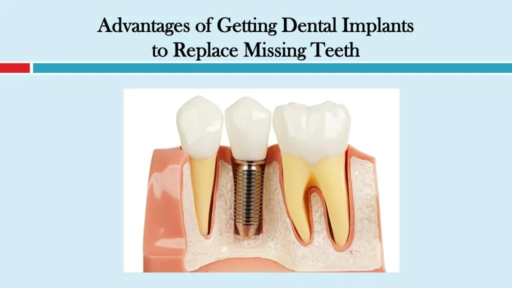 PPT - Advantages of Getting Dental Implants to Replace Missing Teeth ...