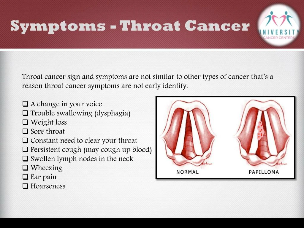 what are the signs of throat cancer