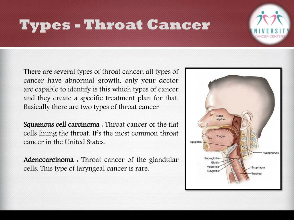 Ppt What Is Throat Cancer And It S Awareness University Cancer Centers Powerpoint 0904