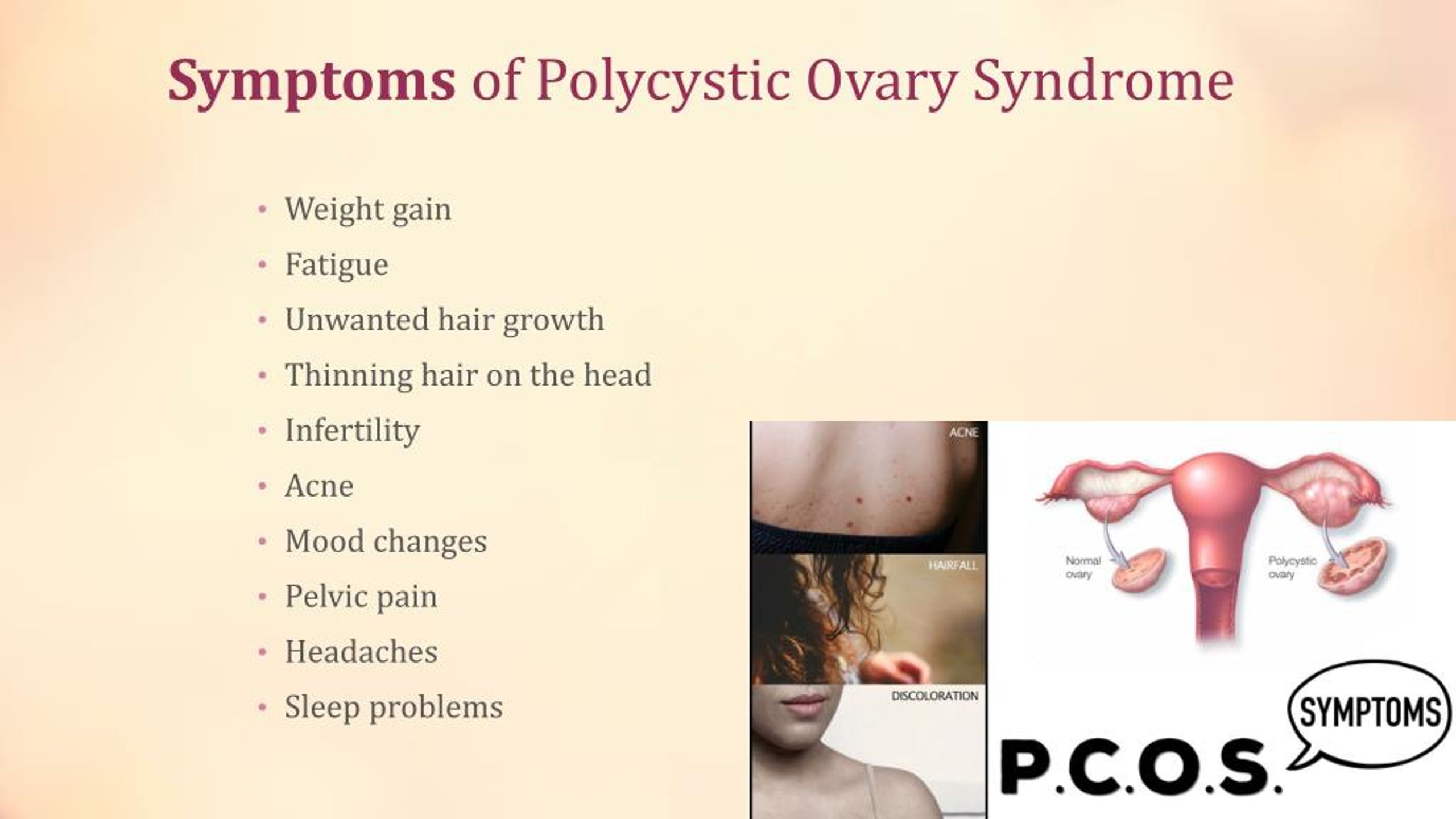 polycystic ovary syndrome symptoms