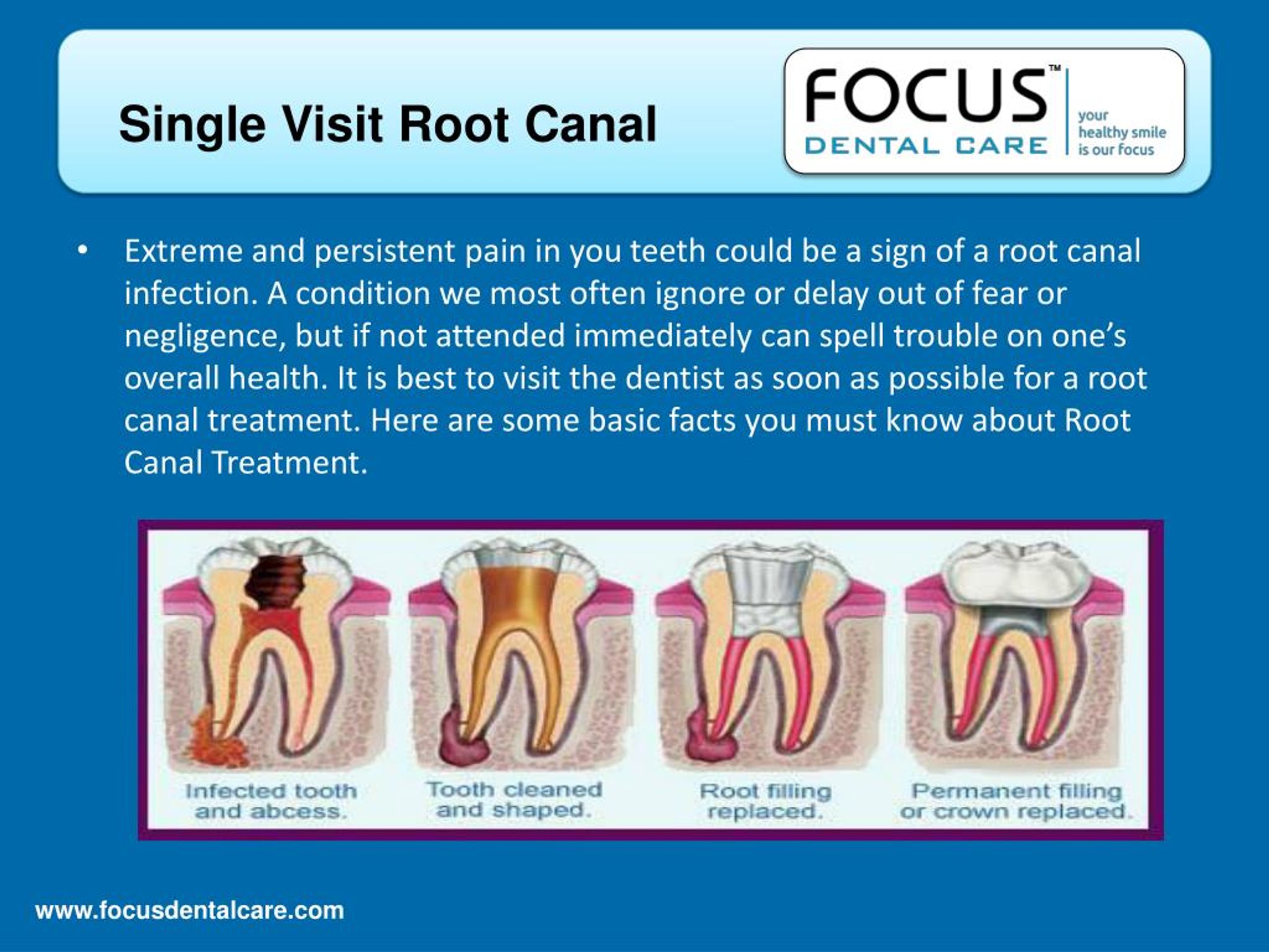 single visit root canal treatment slideshare