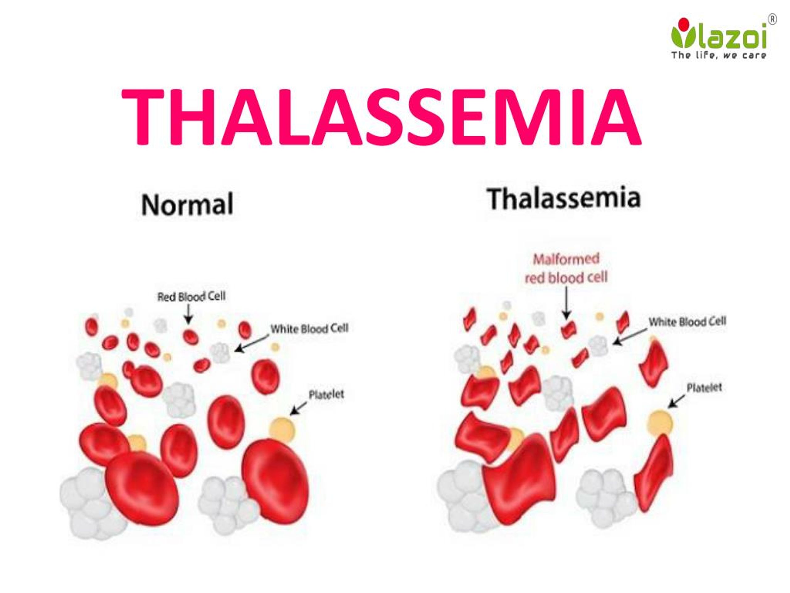 Ppt Thalassemia And Hemoglobinopathies Powerpoint Presentation Free ...