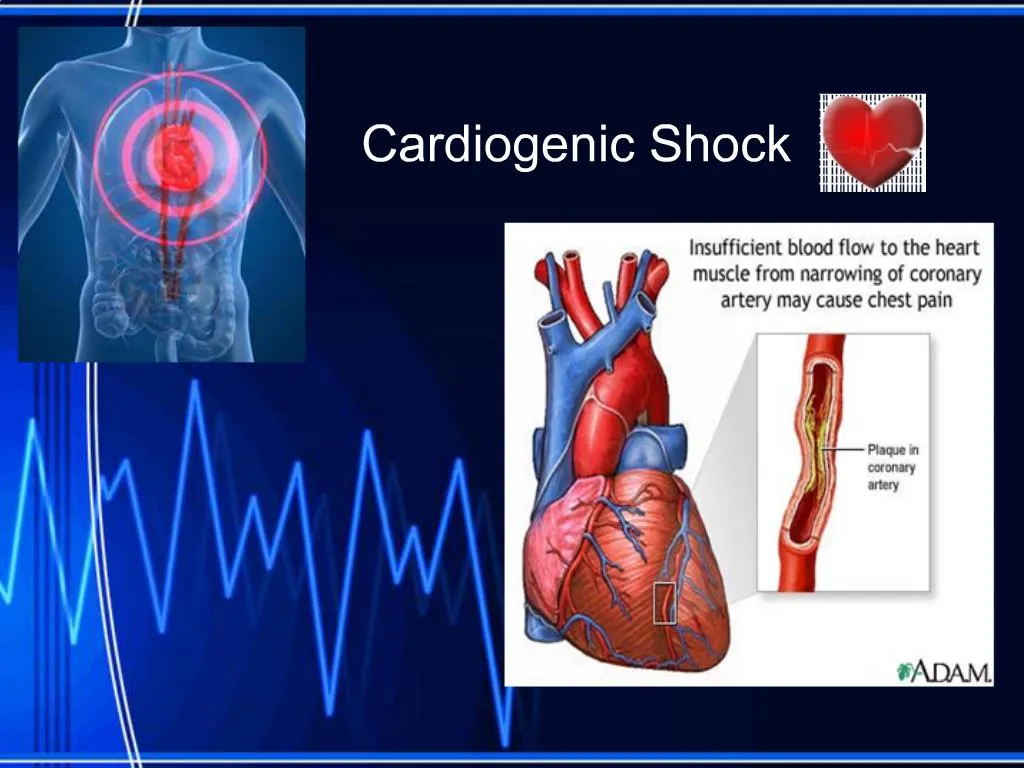 Ppt Cardiogenic Shock Powerpoint Presentation Free Download Id760921 5908