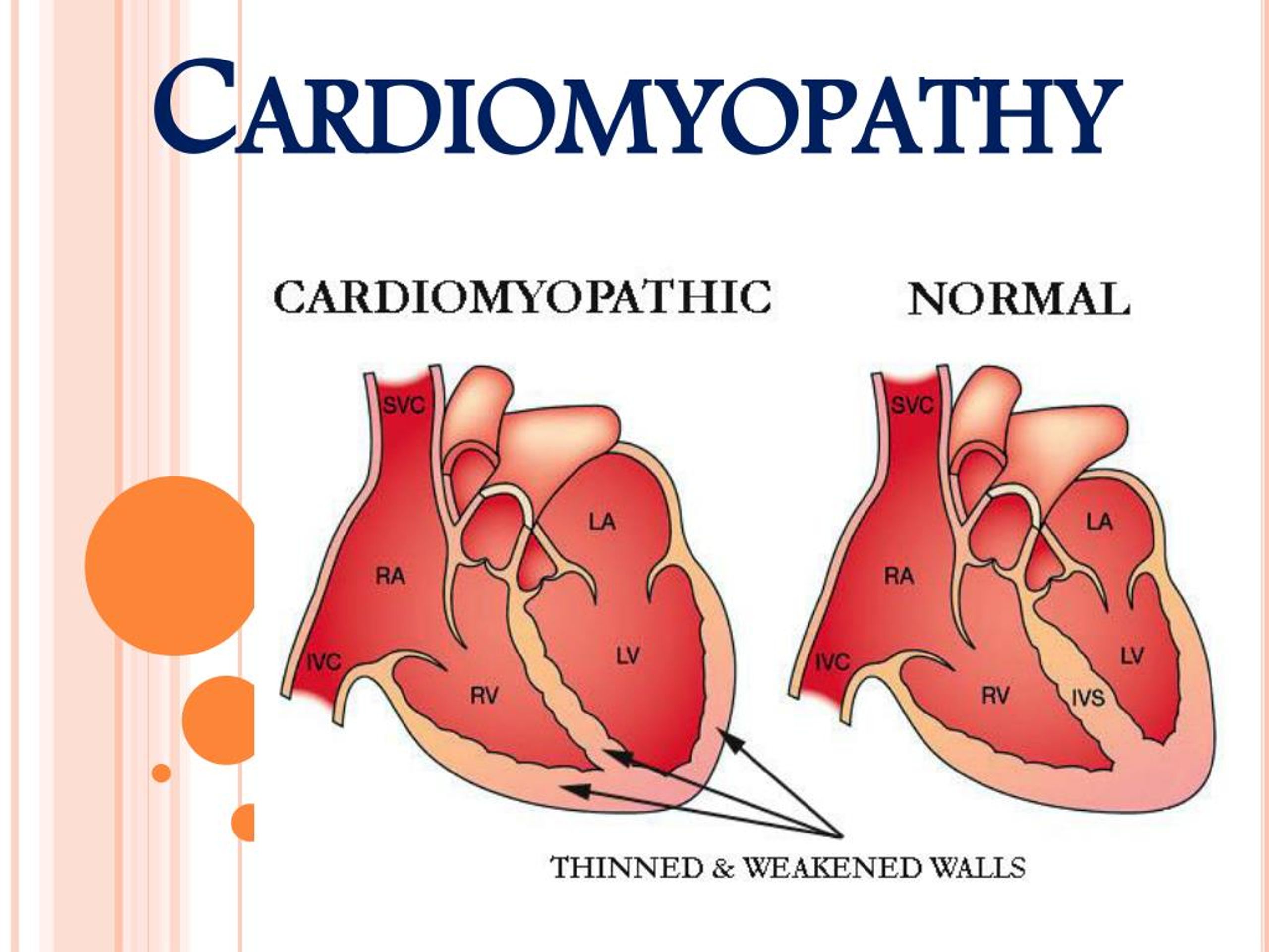 PPT - Heart Muscle Disease (Cardiomyopathy) PowerPoint ...
